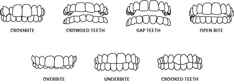 Photo displaying different types of dental misalignments: gapped teeth, open bite, overbite, crossbite, overly crowded teeth, and underbite. Gapped teeth: Spaces between teeth. Open bite: Lack of overlap between upper and lower teeth. Overbite: Upper front teeth excessively cover the lower front teeth. Crossbite: Misalignment of upper and lower teeth in lateral position. Overly crowded teeth: Insufficient space for teeth, causing crowding. Underbite: Lower front teeth protrude past the upper front teeth