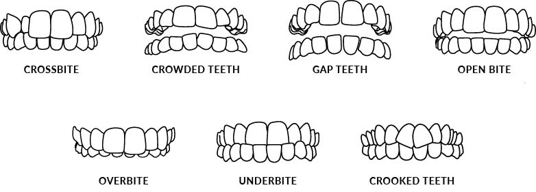 Invisalign Cost Edmonton, AB